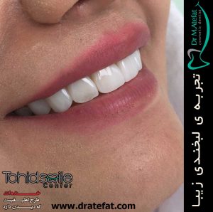 لامینیت دندان