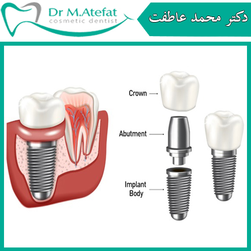 مشخصات ایمپلنت دندان