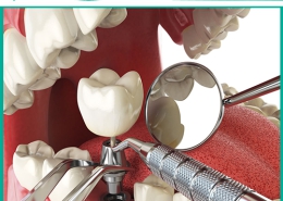 ماندگاری ایمپلنت دندان چقدر است؟