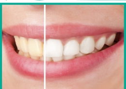 سوالات متداول در مورد سفید شدن دندان ها