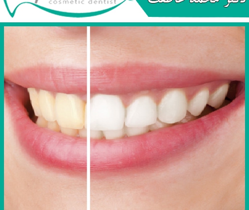 سوالات متداول در مورد سفید شدن دندان ها