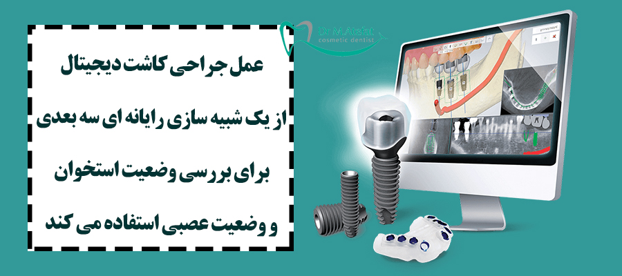 ایمپلنت دیجیتال در اصفهان