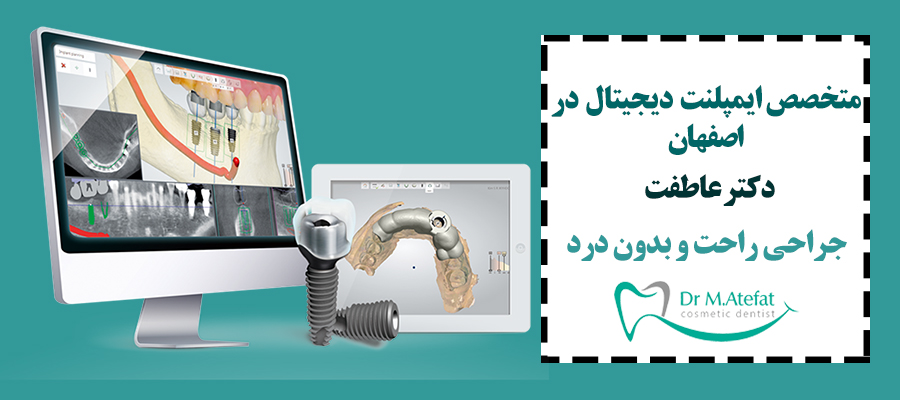 ایمپلنت دیجیتال در اصفهان