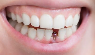 علل ضعیف شدن و افتادن دندان ها