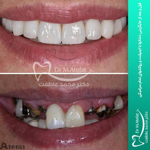 انواع ایمپلنت قبل و بعد از جایگزینی دندانها با ایمپلنت و روکشهای تمام سرامیکی