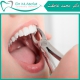 پرکردن دندان یا کشیدن دندان