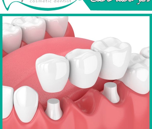 چرا باید دندان های از دست رفته جایگزین شوند