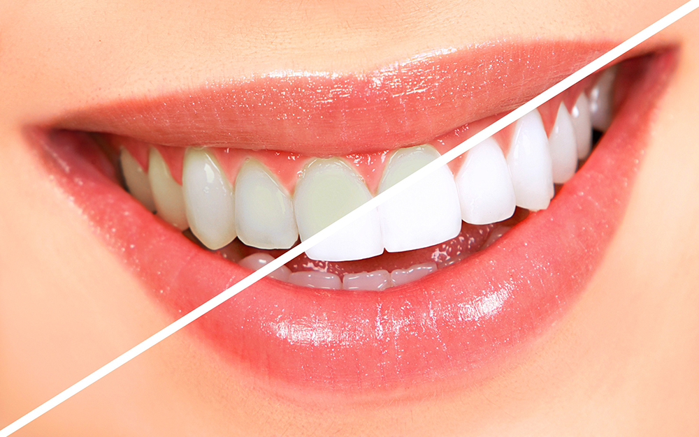 سفید شدن دندان سریع ترین روش سفید شدن دندان