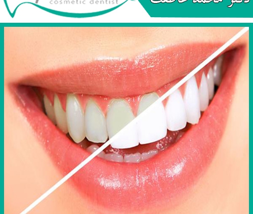 سفید شدن دائمی دندان
