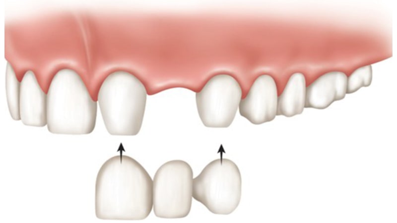 راه حل جایگزین دندان از دست رفته : دندان مصنوعی یا ایمپلنت