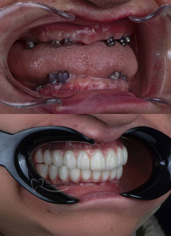متخصص ایمپلنت دندان در اصفهان