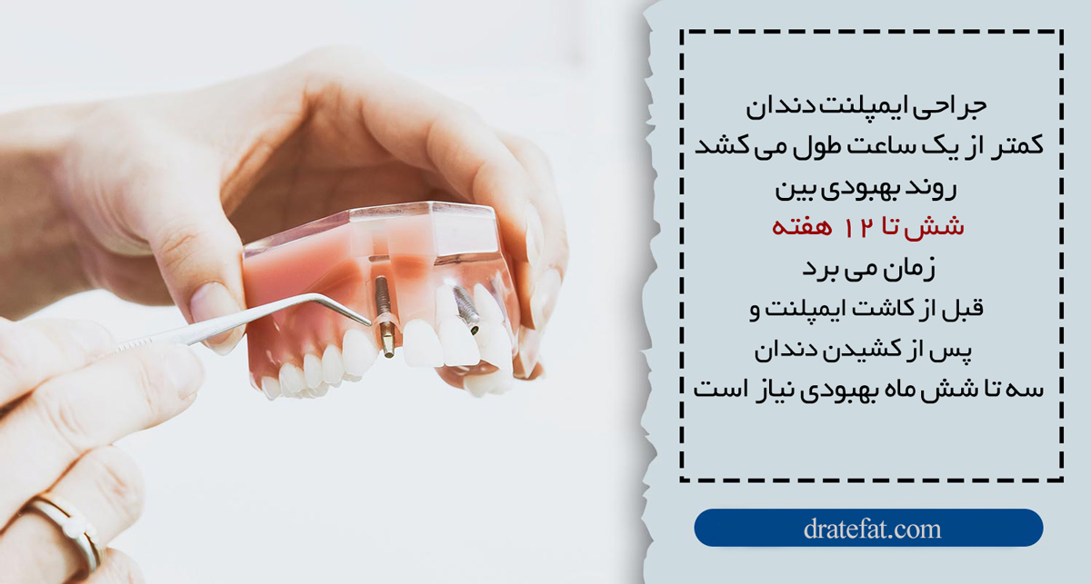 متخصص ایمپلنت دندان در اصفهان