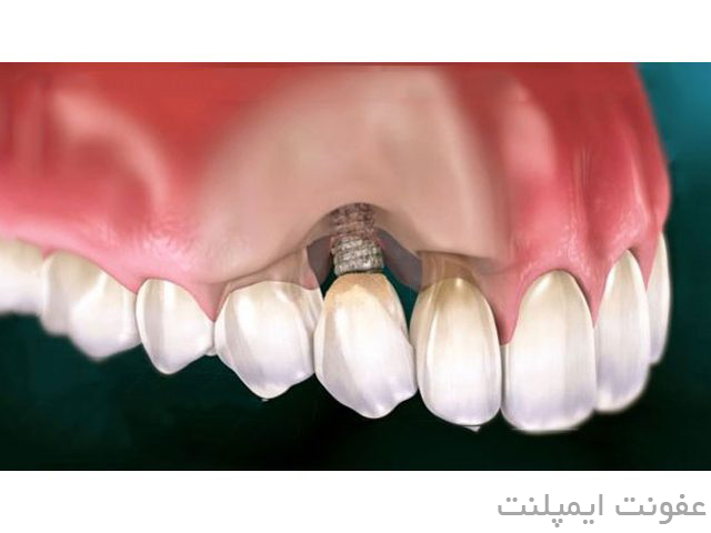 چه زمانی ایمپلنت دندان باید عوض شود