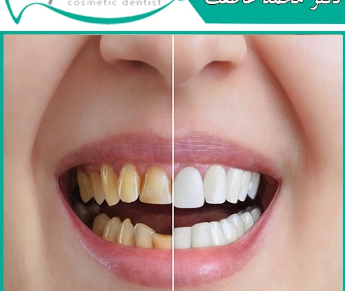 درمان های زیبایی دندان چقدر طول می کشند؟