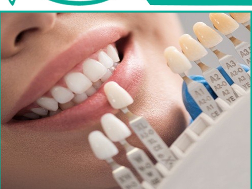 بهترین نوع لمینت دندان چیست؟