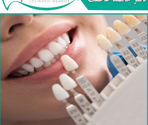 بهترین نوع لمینت دندان چیست؟